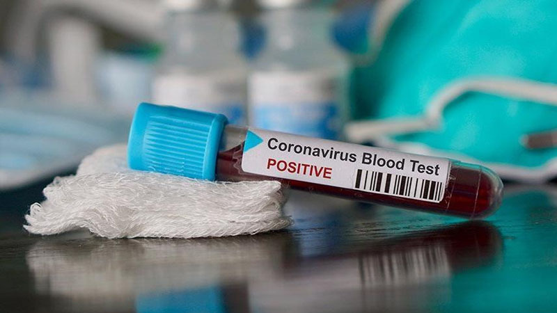Son 24 saatda Azərbaycanda koronavirusa yoluxanların sayı açıqlandı