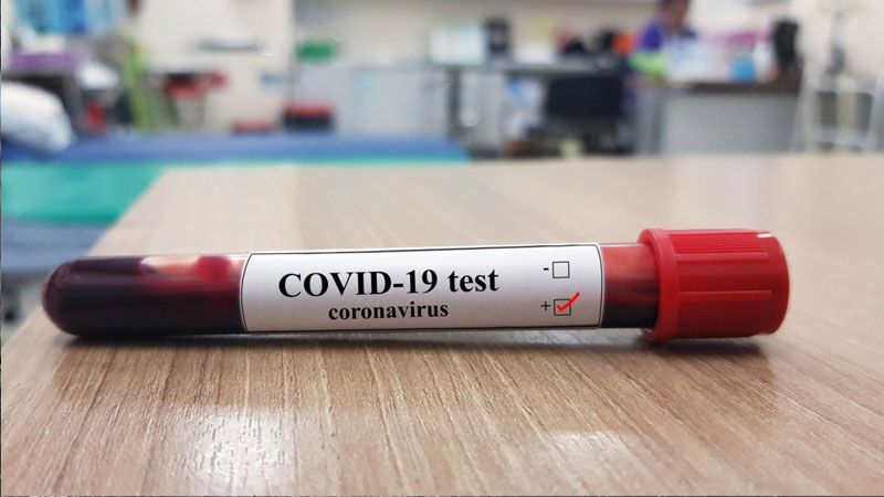 Koronavirus testlərinin qiyməti niyə yüksəkdir? – Deputat açıqladı